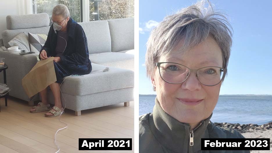 ”Efter ni måneder har jeg det stadig godt, og jeg har et liv med kvalitet og stabilitet, hvor jeg er aktiv med fitness og gåture og sætter stor pris på, at jeg nu kan planlægge ture, koncertbesøg, biograf med mere.  Jeg har fået en ny chance for at leve," siger Birgit. I 2021 fik hun ilt døgnet rundt, men straks efter behandlingen med Lumykras, fik hun det meget bedre. 